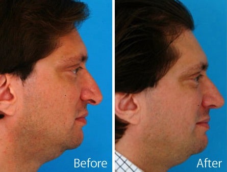 Droopy Nose Before and After Photos in Sewell, NJ, Patient 7085