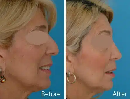 Droopy Nose Before and After Photos in Sewell, NJ, Patient 7096