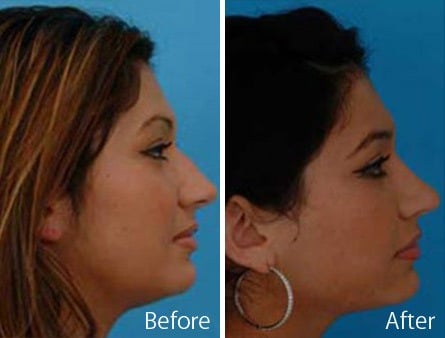 Ethnic Rhinoplasty Before and After Photos in Sewell, NJ, Patient 7155