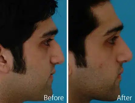 Ethnic Rhinoplasty Before and After Photos in Sewell, NJ