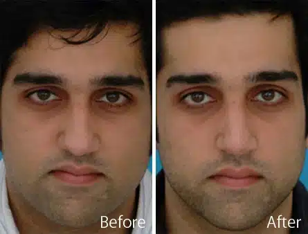 Ethnic Rhinoplasty Before and After Photos in Sewell, NJ, Patient 7157