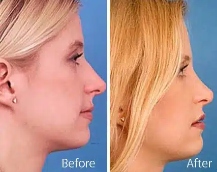 Finesse Rhinoplasty Before and After Photos in Sewell, NJ, Patient 7177