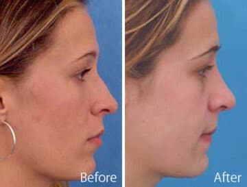 Finesse Rhinoplasty Before and After Photos in Sewell, NJ, Patient 7196