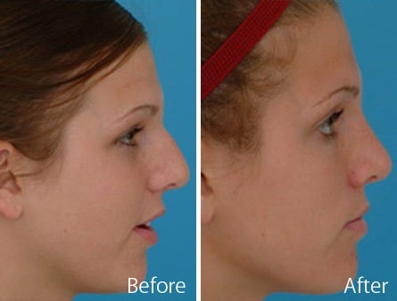 Nasal Bump Before and After Photos in Sewell, NJ, Patient 7222