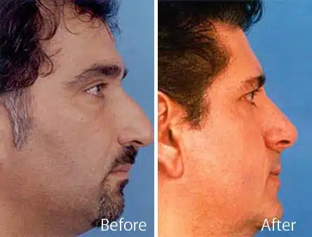 Nasal Bump Before and After Photos in Sewell, NJ, Patient 7289