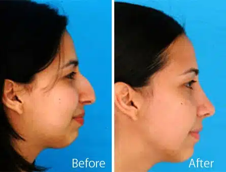 Nasal Bump Before and After Photos in Sewell, NJ, Patient 7323