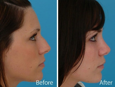 Nasal Bump Before and After Photos in Sewell, NJ, Patient 7352