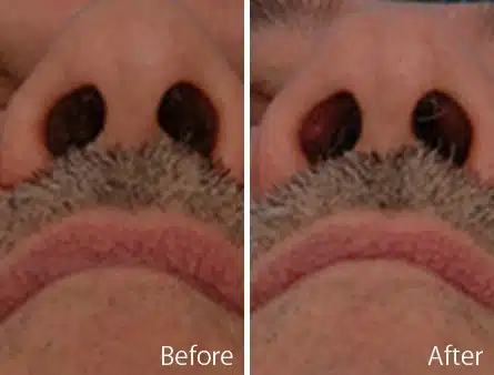 Narrow Nose Before and After Photos in Sewell, NJ, Patient 7400