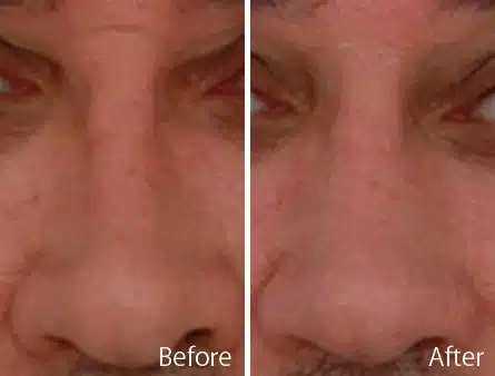 Narrow Nose Before and After Photos in Sewell, NJ, Patient 7400