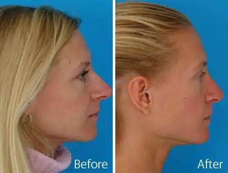 Overprojected Before and After Photos in Sewell, NJ, Patient 7459