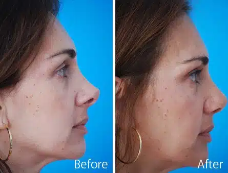 Revision Rhinoplasty Before and After Photos in Sewell, NJ, Patient 7522