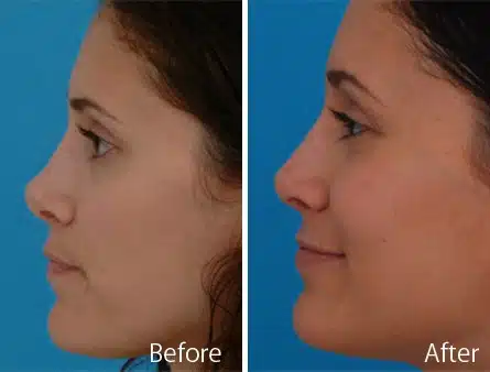 Revision Rhinoplasty Before and After Photos in Sewell, NJ, Patient 7529