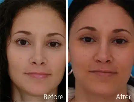 Revision Rhinoplasty Before and After Photos in Sewell, NJ, Patient 7529