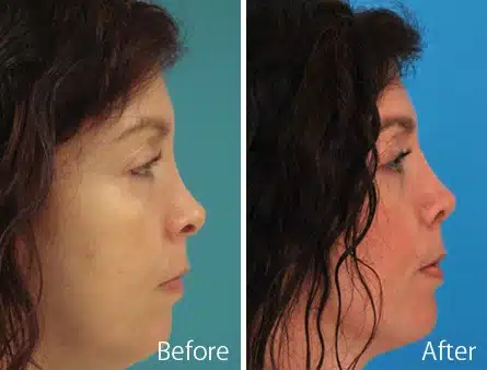 Revision Rhinoplasty Before and After Photos in Sewell, NJ, Patient 7543