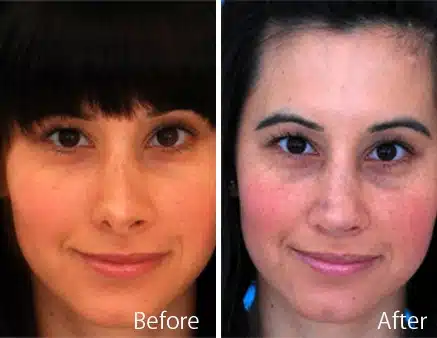 Revision Rhinoplasty Before and After Photos in Sewell, NJ, Patient 7767