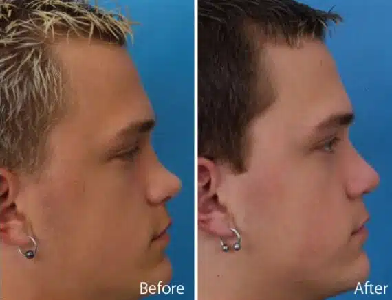 Saddle Nose Before and After Photos in Sewell, NJ, Patient 7794