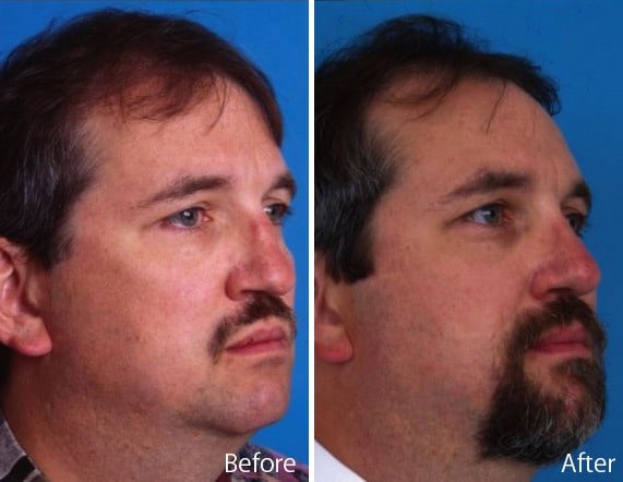 Saddle Nose Before and After Photos in Sewell, NJ, Patient 7797