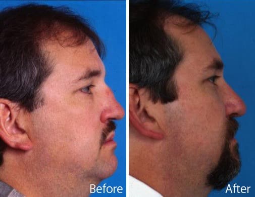 Saddle Nose Before and After Photos in Sewell, NJ, Patient 7797