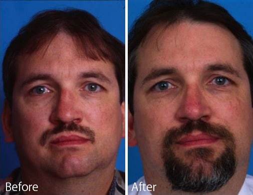 Saddle Nose Before and After Photos in Sewell, NJ, Patient 7797