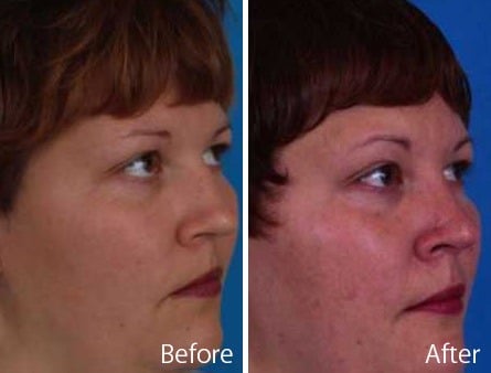 Saddle Nose Before and After Photos in Sewell, NJ, Patient 7815