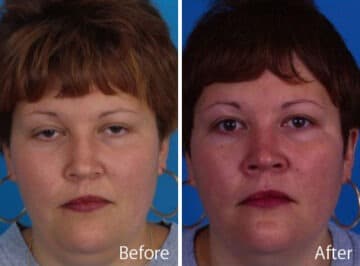 Saddle Nose Before and After Photos in Sewell, NJ, Patient 7815