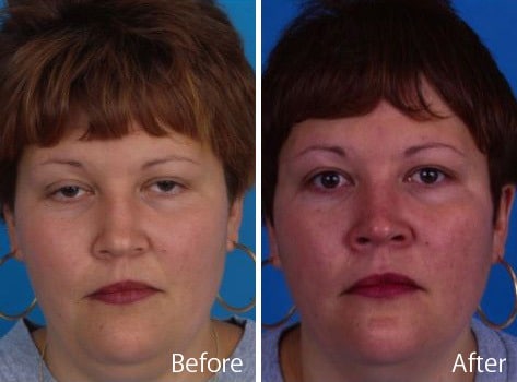 Saddle Nose Before and After Photos in Sewell, NJ, Patient 7815