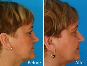 Saddle Nose Before and After Photos in Sewell, NJ, Patient 7818