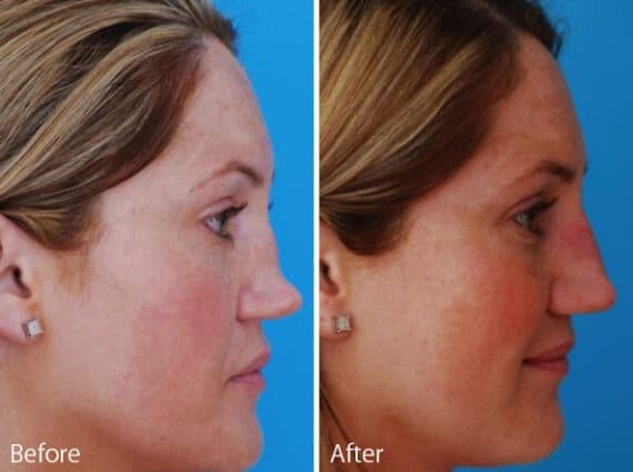 Saddle Nose Before and After Photos in Sewell, NJ, Patient 7820