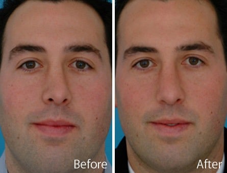 Twisted Nose Before and After Photos in Sewell, NJ, Patient 7825