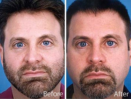 Twisted Nose Before and After Photos in Sewell, NJ, Patient 7868