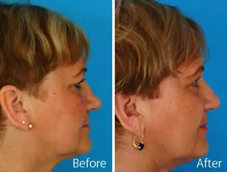 Upturned Nose Before and After Photos in Sewell, NJ, Patient 7889