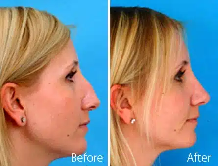 Wide Nose Before and After Photos in Sewell, NJ, Patient 7906