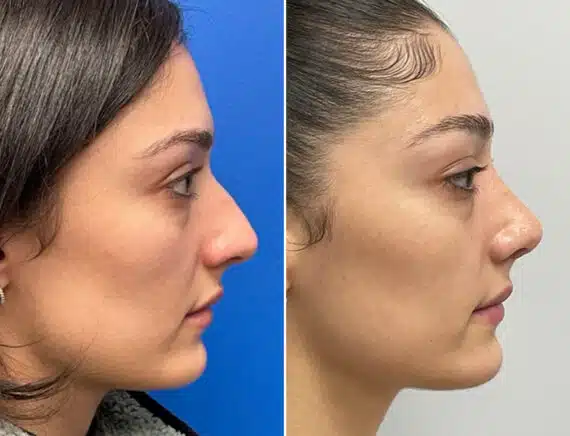 Finesse Rhinoplasty Before and After Photos in Sewell, NJ, Patient 10323