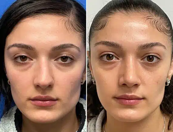 Finesse Rhinoplasty Before and After Photos in Sewell, NJ, Patient 10323