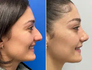 Finesse Rhinoplasty Before and After Photos in Sewell, NJ, Patient 10323