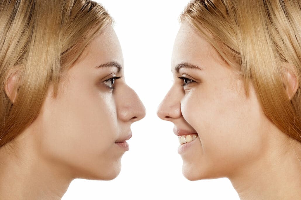 Pollybeak Deformity Before and After Rhinoplasty Surgery