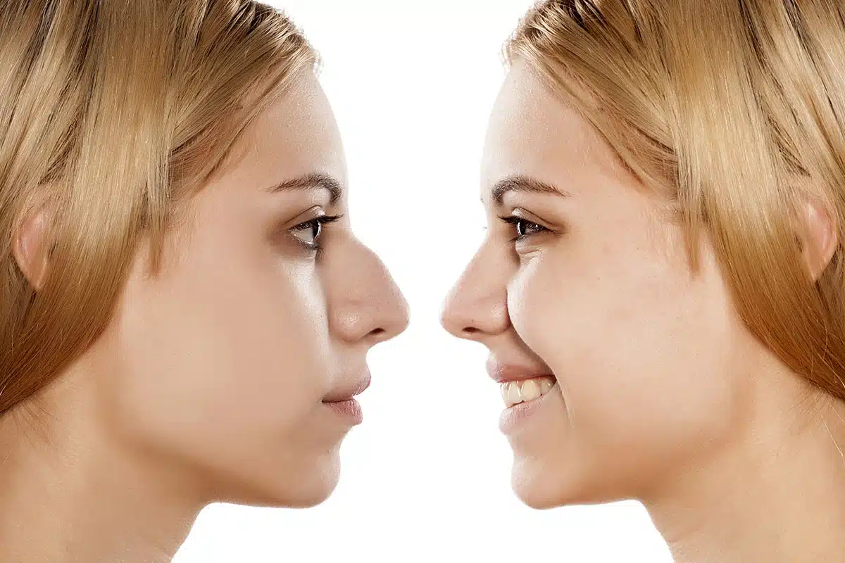Pollybeak Deformity Before and After Rhinoplasty Surgery