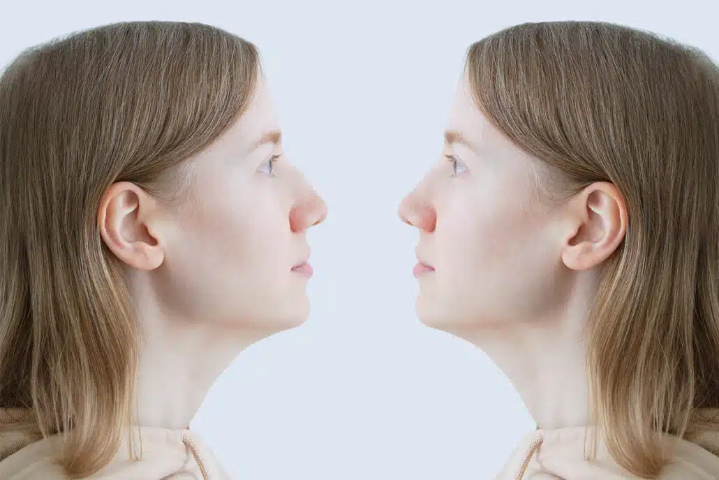 Dr. Becker and the team at Becker Rhinoplasty Center are experienced in performing aquiline nose jobs to help patients achieve a straightened nose and improved facial appearance.