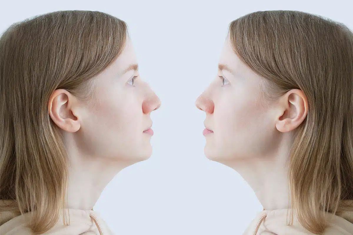 Explore the surgical options for correcting a hooked nose and what to expect from the procedure.