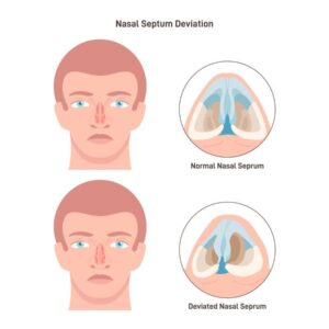 Septor Rhinolasty Septorhinoplasty Surgery: What It Is & When You May Need It