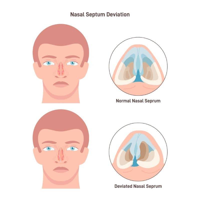 Medical illustration comparing normal nasal septum to deviated septum, highlighting airflow obstruction and nasal structure.